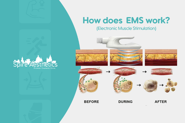 EMS treatment for post pregnancy weight loss treatment Carlton