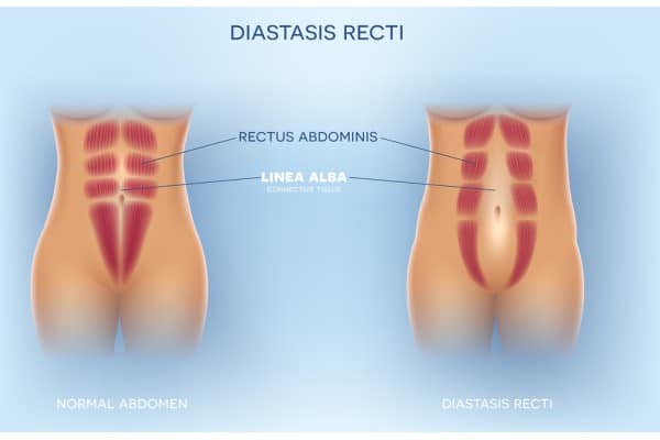 What Non-Surgical Options Are Available for Diastasis Recti Carlton?