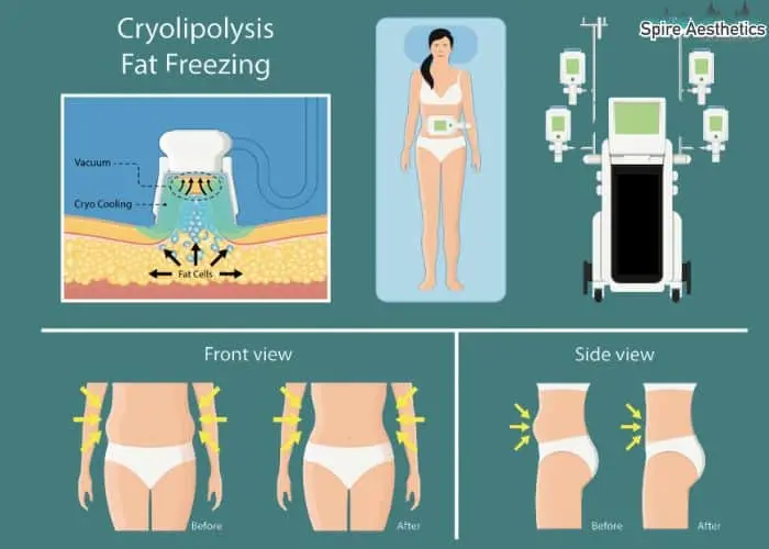 Fat freezing treatment Carlton benefits for competitions to remove stubborn fat deposits.