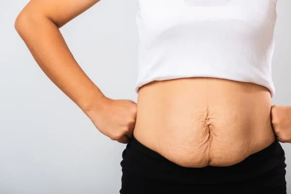 Image of a woman's stomach after weight loss with sagging skin following a gastric band Carlton