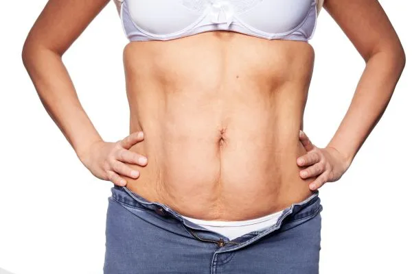 sagging skin on woman's stomach after weight loss injections Carlton