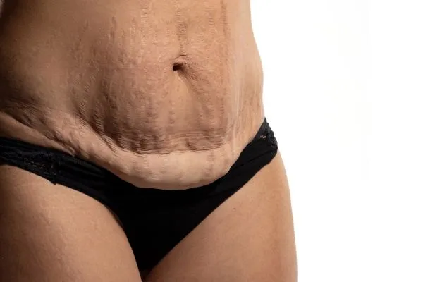 Image of womans stomach after weight loss injections Carlton showing saggy skin
