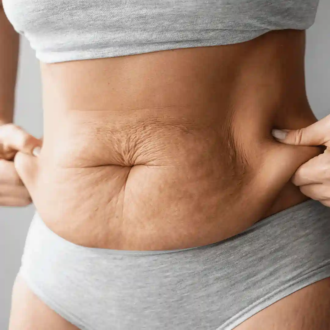 Is It Normal to Have Loose Skin After Pregnancy Carlton?