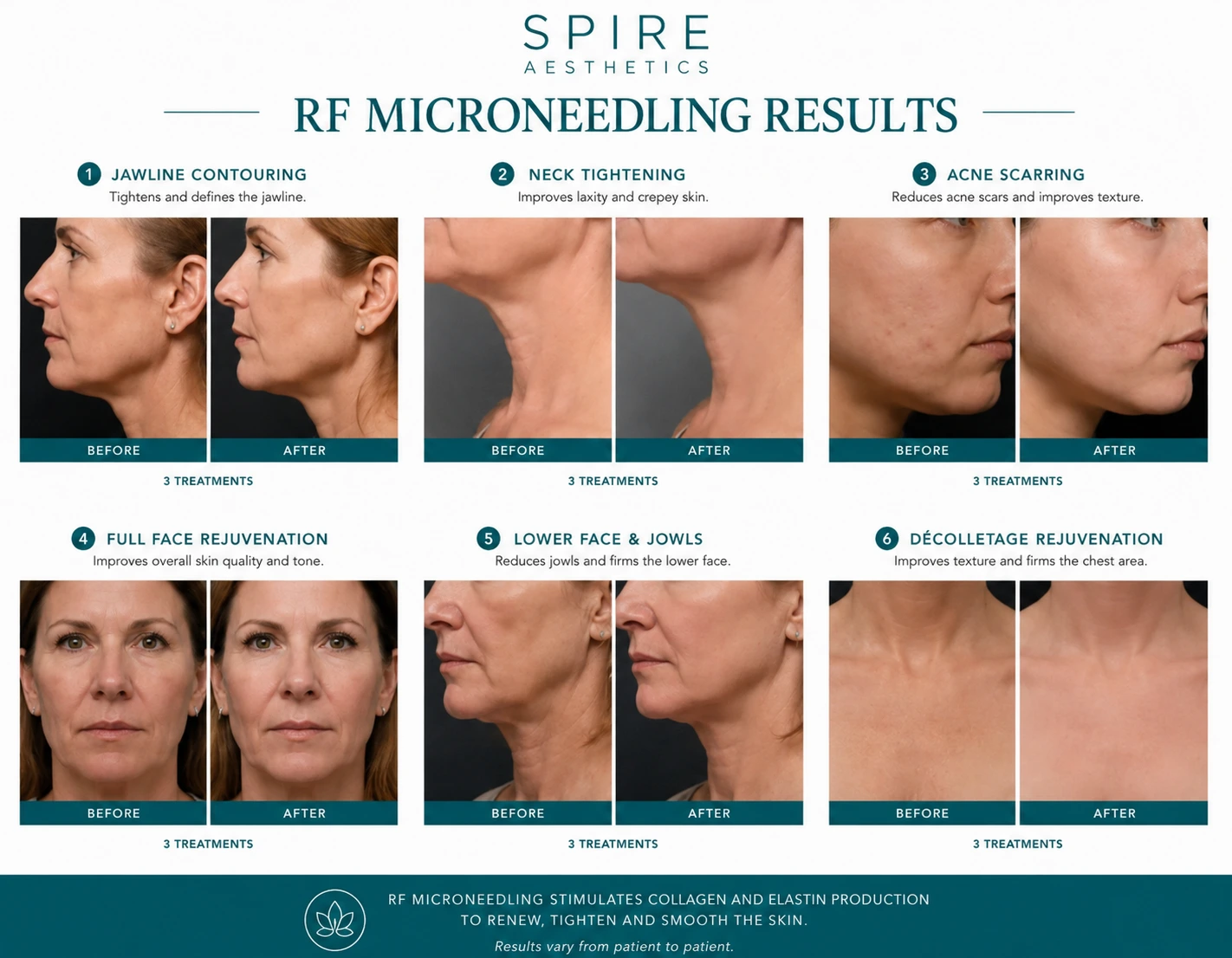 RF Microneedling Skin tightening Carlton results