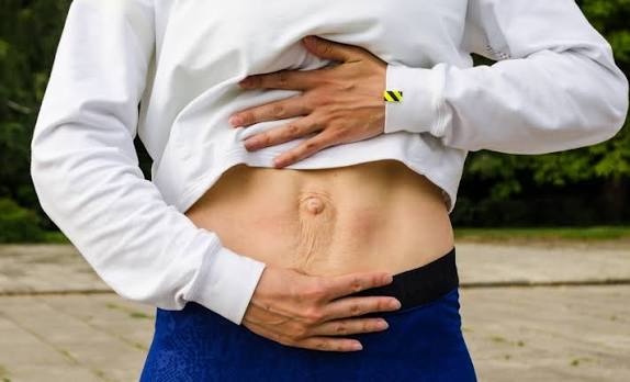 When Could Diastasis Recti Be the Missing Piece of the Puzzle Carlton?
