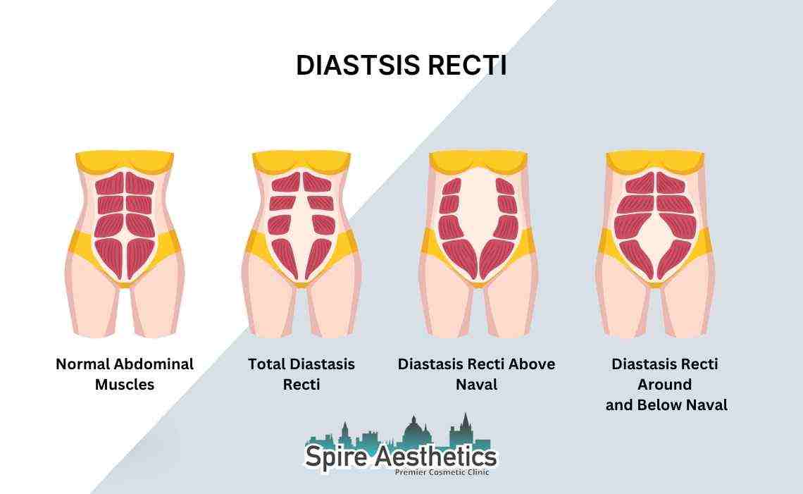 Is Non-Surgical Diastasis Recti Treatment Right for You? Common Concerns Answered Carlton